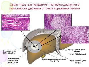 Сравнительные показатели тканевого давления в зависимости удаления от очага пора