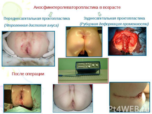 Хирургическая коррекция врожденной воронкообразной деформации грудной клетки у детей