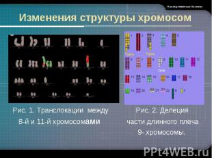 Рис. 1. Транслокации между Рис. 2. Делеция 8-й и 11-й хромосомами части длинного