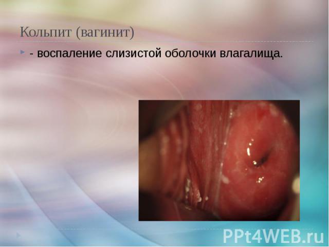 Кольпит (вагинит) - воспаление слизистой оболочки влагалища.