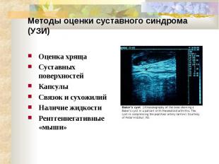 Методы оценки суставного синдрома (УЗИ) Оценка хряща Суставных поверхностей Капс