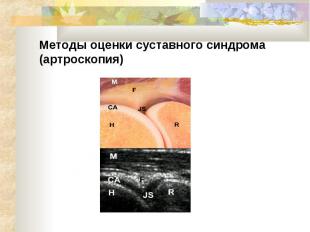 Методы оценки суставного синдрома (артроскопия)