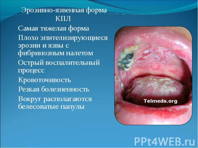 Кпл на коже фото