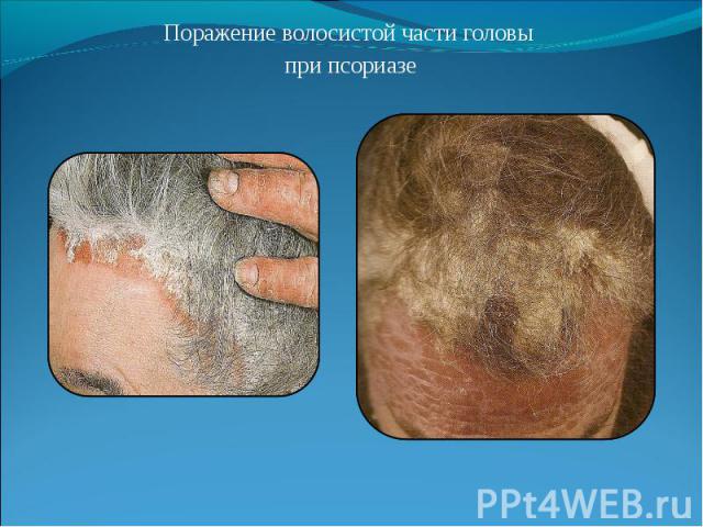 Поражение волосистой части головы Поражение волосистой части головы при псориазе