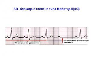 AВ- блокада 2 степени типа Мобитца II(4:3)