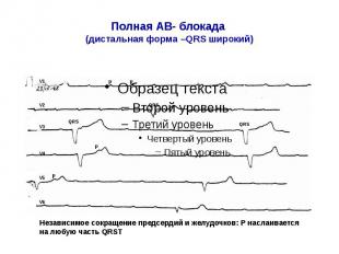 Полная АВ- блокада (дистальная форма –QRS широкий)