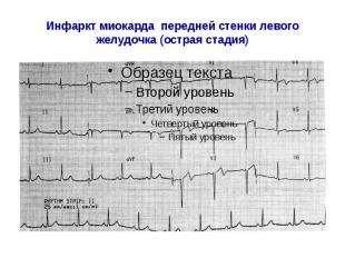 Инфаркт миокарда передней стенки левого желудочка (острая стадия)