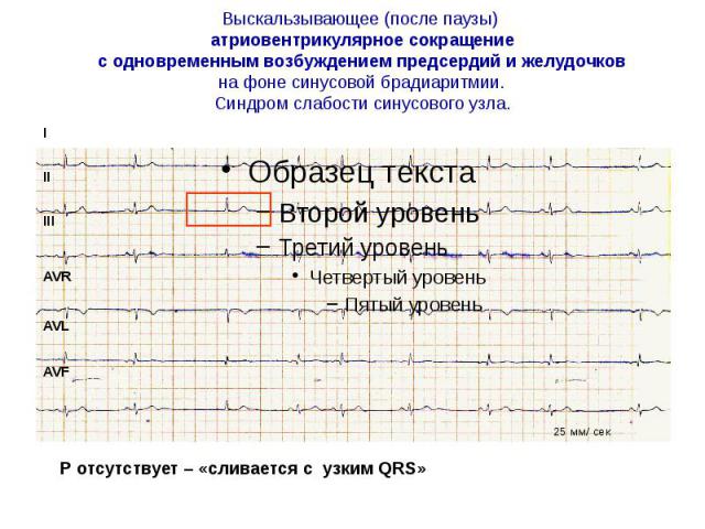 Выскальзывающее (после паузы) атриовентрикулярное сокращение с одновременным возбуждением предсердий и желудочков на фоне синусовой брадиаритмии. Синдром слабости синусового узла.