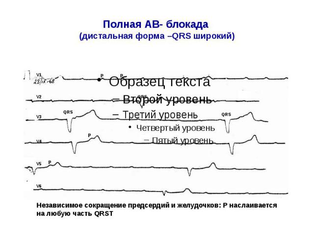 Полная блокада мкб