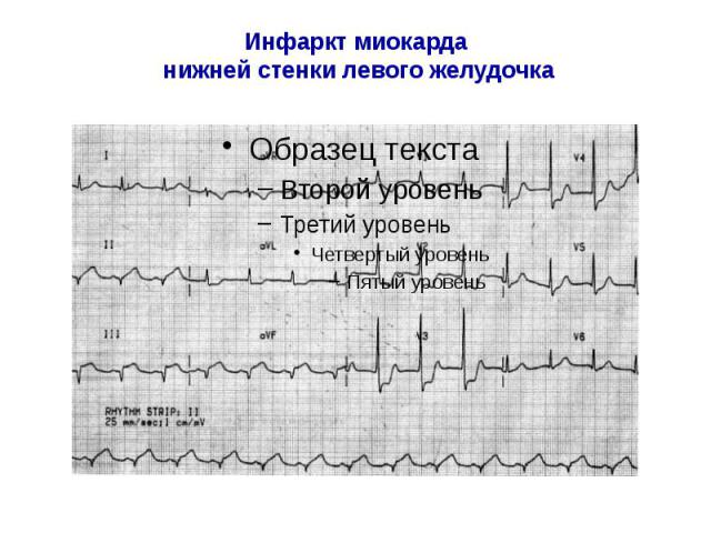 Инфаркт миокарда нижней стенки левого желудочка