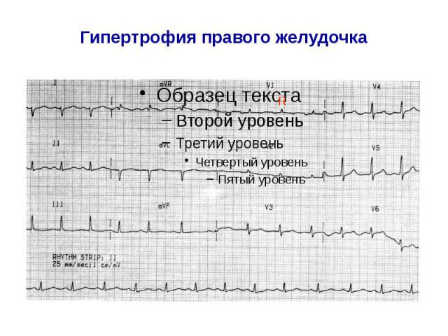 Гипертрофия правого желудочка