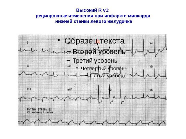 Высокий R v1: реципрокные изменения при инфаркте миокарда нижней стенки левого желудочка