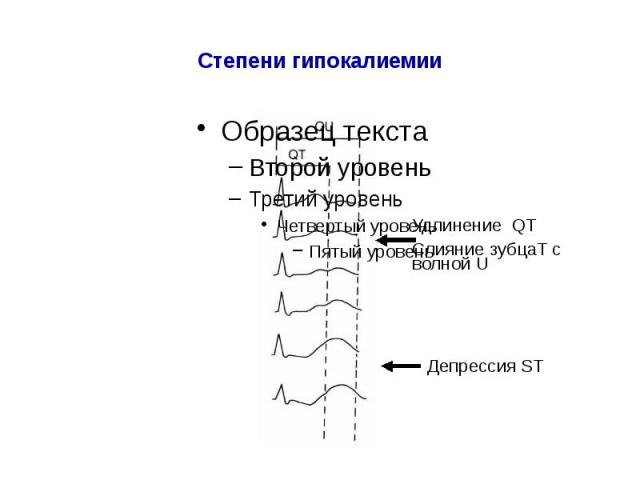 Степени гипокалиемии