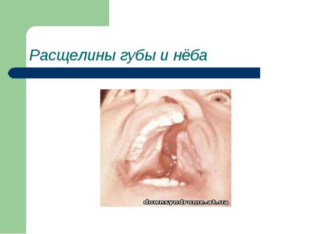 Расщелины губы и нёба