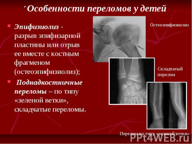 Особенности переломов у детей Эпифизиолиз - разрыв эпифизарной пластины или отрыв ее вместе с костным фрагменом (остеоэпифизиолиз); Поднадкостничные переломы – по типу «зеленой ветки», складчатые переломы.