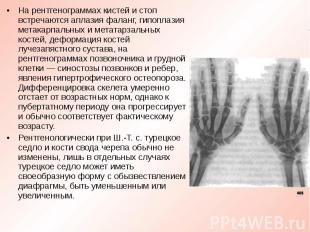 На рентгенограммах кистей и стоп встречаются аплазия фаланг, гипоплазия метакарп