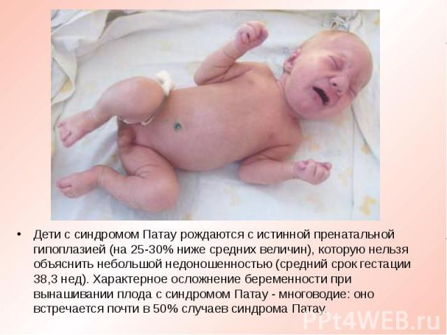 Дети с синдромом Патау рождаются с истинной пренатальной гипоплазией (на 25-30% ниже средних величин), которую нельзя объяснить небольшой недоношенностью (средний срок гестации 38,3 нед). Характерное осложнение беременности при вынашивании плода с с…