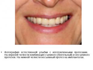 Фотография естественной улыбки с изготовленными протезами. На верхней челюсти ко