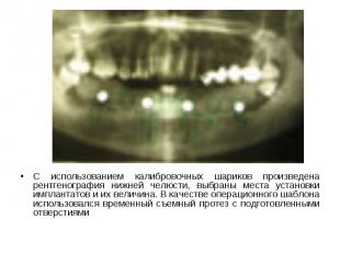 С использованием калибровочных шариков произведена рентгенография нижней челюсти