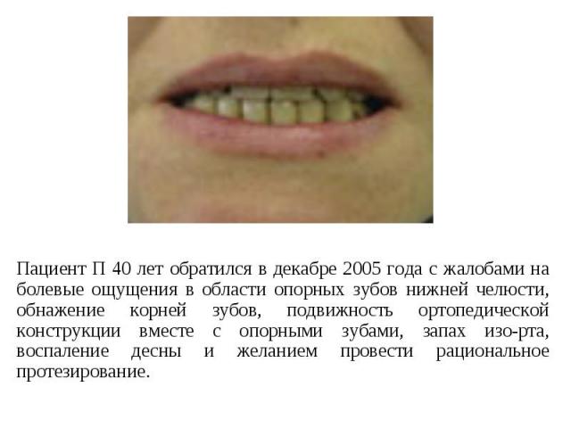 Пациент П 40 лет обратился в декабре 2005 года с жалобами на болевые ощущения в области опорных зубов нижней челюсти, обнажение корней зубов, подвижность ортопедической конструкции вместе с опорными зубами, запах изо-рта, воспаление десны и желанием…