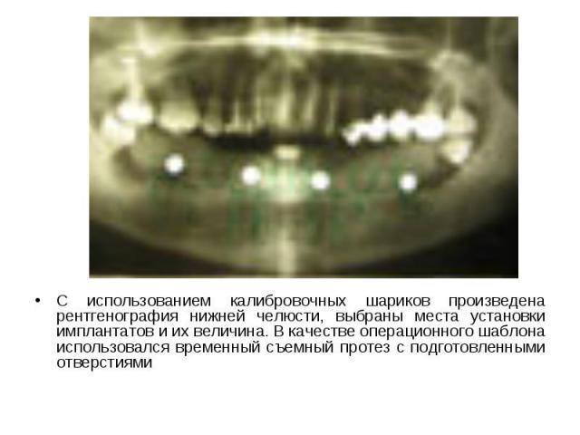 С использованием калибровочных шариков произведена рентгенография нижней челюсти, выбраны места установки имплантатов и их величина. В качестве операционного шаблона использовался временный съемный протез с подготовленными отверстиями  С исполь…