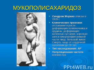 МУКОПОЛИСАХАРИДОЗ Синдром Моркио описан в 1929 г. Клинические признаки: отставан