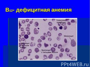 В12- дефицитная анемия