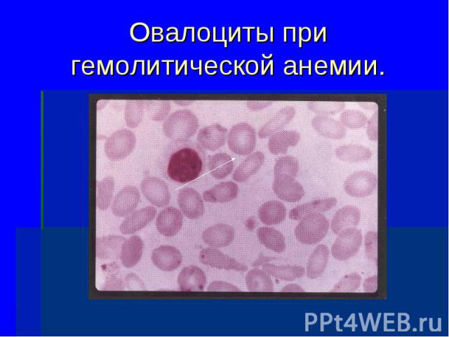 Овалоциты при гемолитической анемии.