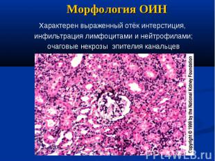 Морфология ОИН Характерен выраженный отёк интерстиция, инфильтрация лимфоцитами