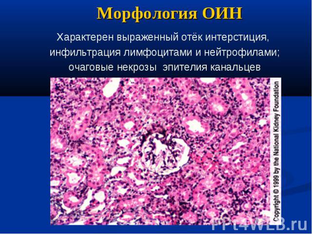 Морфология ОИН Характерен выраженный отёк интерстиция, инфильтрация лимфоцитами и нейтрофилами; очаговые некрозы эпителия канальцев