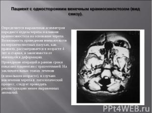 Определяется выраженная асимметрия переднего отдела черепа и влияние краниосинос