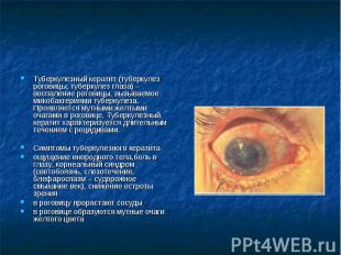 Туберкулезный кератит (туберкулез роговицы, туберкулез глаза) – воспаление рогов