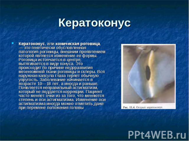 Кератоконус Кератоконус, или коническая роговица, — это генетически обусловленная патология роговицы, внешним проявлением которой является изменение ее формы. Роговица истончается в центре, вытягивается в виде конуса. Это происходит по причине недор…