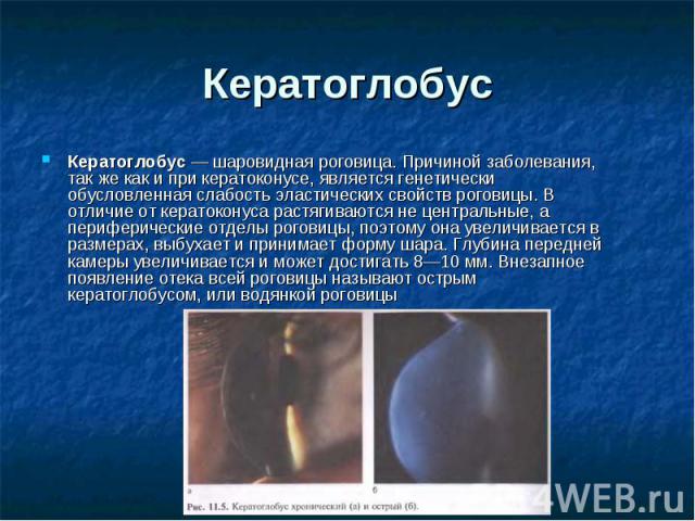 Кератоглобус Кератоглобус — шаровидная роговица. Причиной заболевания, так же как и при кератоконусе, является генетически обусловленная слабость эластических свойств роговицы. В отличие от кератоконуса растягиваются не центральные, а периферич…