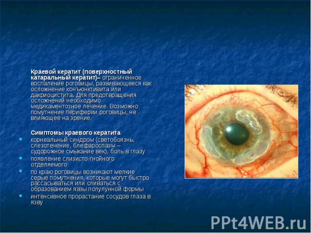 Краевой кератит (поверхностный катаральный кератит)– ограниченное воспаление роговицы, развивающееся как осложнение конъюнктивита или дакриоцистита. Для предотвращения осложнений необходимо медикаментозное лечение. Возможно помутнение периферии рого…