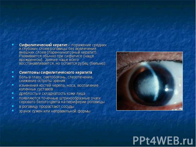 Сифилитический кератит – поражение средних и глубоких слоев роговицы без вовлечения внешних слоев (паренхиматозный кератит). Развивается обычно при сифилисе (чаще врожденном). Зрение чаще всего восстанавливается, но остается рубец (бельмо). Симптомы…
