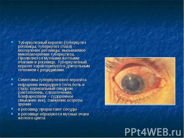 Туберкулезный кератит (туберкулез роговицы, туберкулез глаза) – воспаление роговицы, вызываемое микобактериями туберкулеза. Проявляется мутными желтыми очагами в роговице. Туберкулезный кератит характеризуется длительным течением с рецидивами. Симпт…