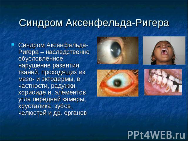 Синдром Аксенфельда-Ригера Синдром Аксенфельда-Ригера – наследственно обусловленное нарушение развития тканей, проходящих из мезо- и эктодермы, в частности, радужки, хориоиде и, элементов угла передней камеры, хрусталика, зубов, челюстей и др. органов
