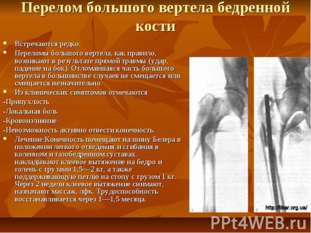 Перелом большого вертела бедренной кости Встречаются редко. Переломы большого вертела, как правило, возникают в результате прямой травмы (удар, падение на бок). Отломавшаяся часть большого вертела в большинстве случаев не смещается или смещается нез…
