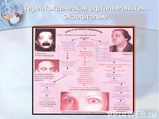 Тиреотоксическая офтальмопатия. Экзофтальм
