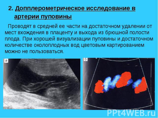 2. Допплерометрическое исследование в артерии пуповины 2. Допплерометрическое исследование в артерии пуповины