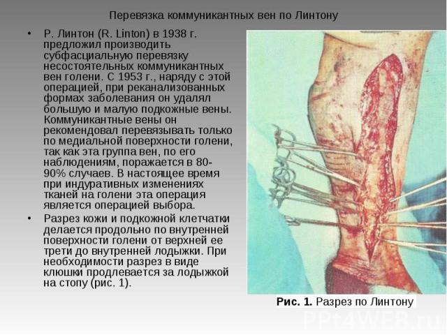 Р. Линтон (R. Linton) в 1938 г. предложил производить субфасциальную перевязку несостоятельных коммуникантных вен голени. С 1953 г., наряду с этой операцией, при реканализованных формах заболевания он удалял большую и малую подкожные вены. Коммуника…