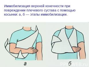 Иммобилизация верхней конечности при повреждении плечевого сустава с помощью кос