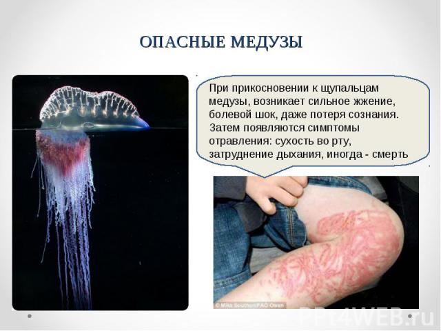 ОПАСНЫЕ МЕДУЗЫПри прикосновении к щупальцам медузы, возникает сильное жжение, болевой шок, даже потеря сознания. Затем появляются симптомы отравления: сухость во рту, затруднение дыхания, иногда - смерть