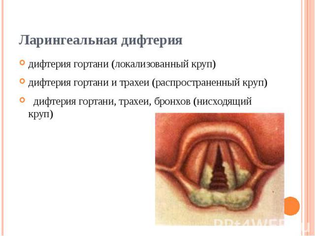 Ларингеальная дифтерия дифтерия гортани (локализованный круп) дифтерия гортани и трахеи (распространенный круп)   дифтерия гортани, трахеи, бронхов (нисходящий круп)